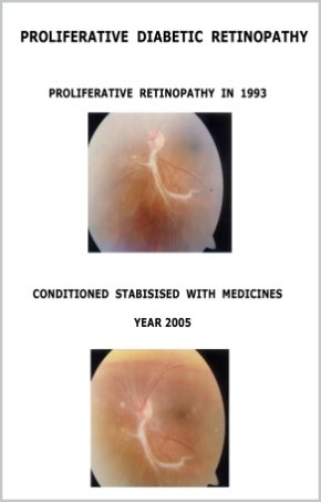 Diabetic Retinopathy